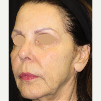 65-74 year old woman treated with Voluma before 3120462