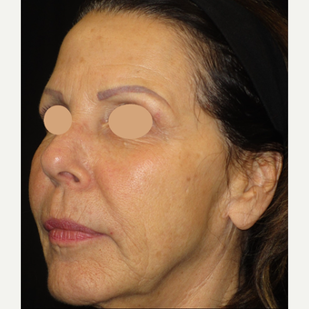 65-74 year old woman treated with Voluma after 3120462