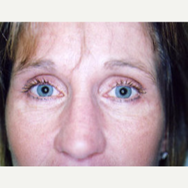 45-54 year old woman treated with Eyelid Surgery after 3748335