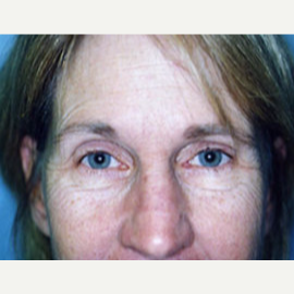 45-54 year old woman treated with Eyelid Surgery before 3748335