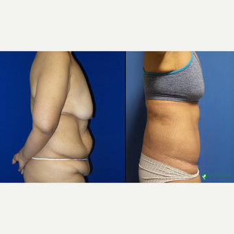 18-24 year old woman treated with Body Lift before 3253867
