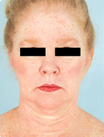 Smart Lipo before 1029371