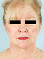 Smart Lipo after 1029371