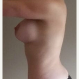 25-34 year old woman treated with Breast Augmentation after 3826470
