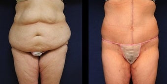 42 year old woman body lift before 1254291