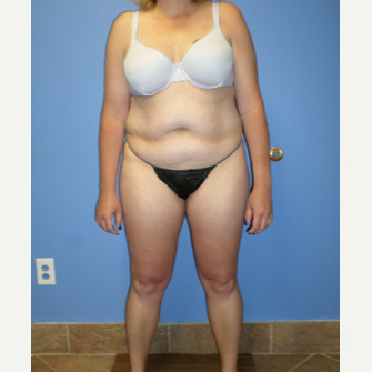 35-44 year old woman treated with Weight Loss before 3370193