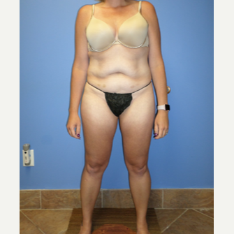 35-44 year old woman treated with Weight Loss after 3370193