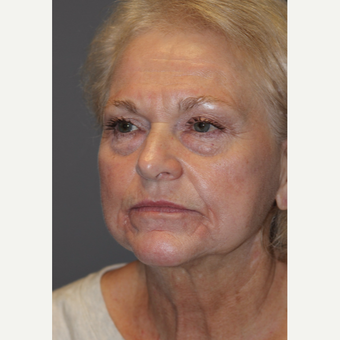 65-74 year old woman treated with Facelift before 3383804
