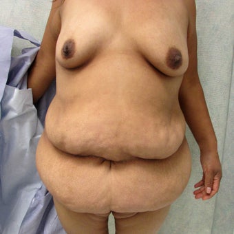Body Contouring for Weight Loss before 1757051