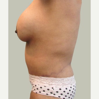 Body Contouring for Weight Loss 1757051
