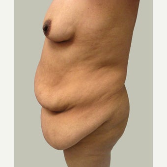 Body Contouring for Weight Loss 1757051
