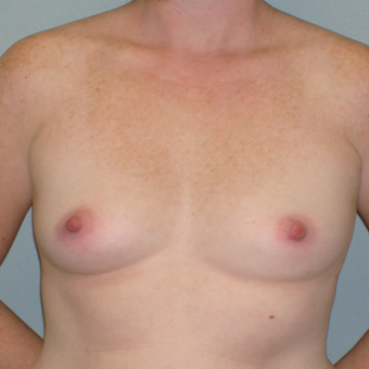 25-34 year old woman treated with Breast Augmentation before 3823077