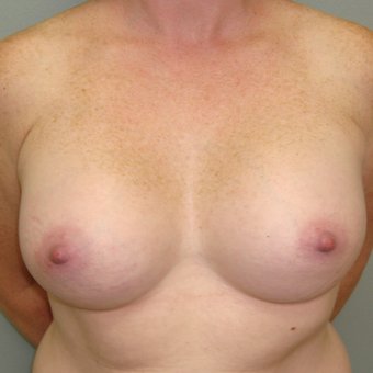 25-34 year old woman treated with Breast Augmentation after 3823077