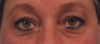 upper blepharoplasty including upper eyelid skin laser resurfacing before 3166870