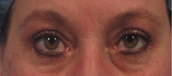 upper blepharoplasty including upper eyelid skin laser resurfacing after 3166870