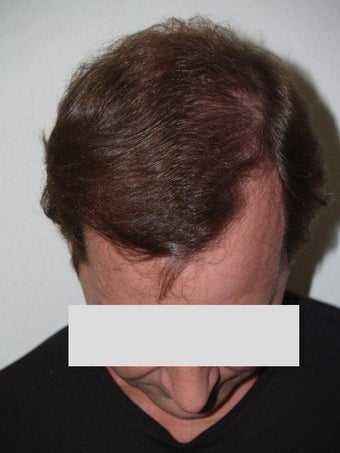 Hair Transplant after 198854