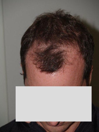 Hair Transplant before 198854
