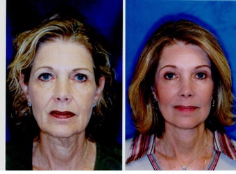Face Lift, Coapt Cheek Lift, Neck Lift Upper and Lower Bleph and Brow Lift before 296171