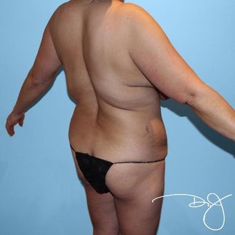 Brazilian Butt Augmentation before 992588