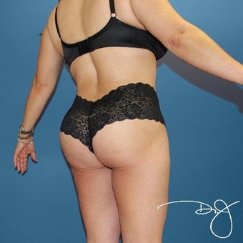 Brazilian Butt Augmentation after 992588