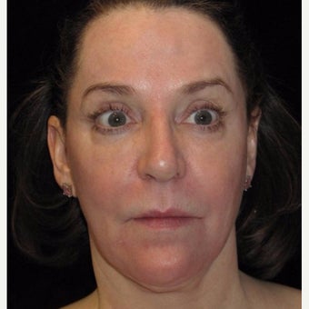 58 year old woman treated with Halo Laser after 2296170