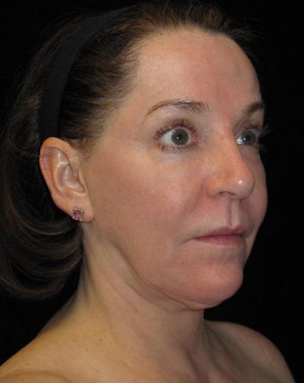 58 year old woman treated with Halo Laser 2296170