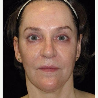 58 year old woman treated with Halo Laser before 2296170