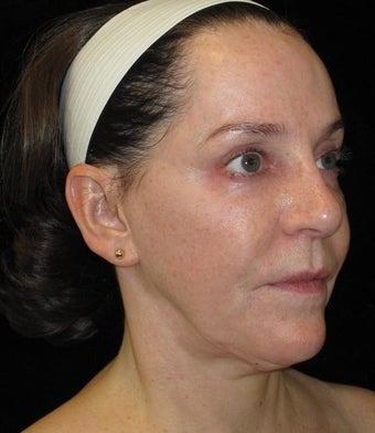 58 year old woman treated with Halo Laser 2296170