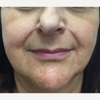 55-64 year old woman treated with Injectable Fillers before 3271451