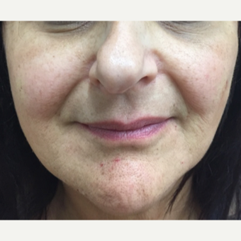 55-64 year old woman treated with Injectable Fillers after 3271451