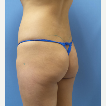 18-24 year old woman treated with Butt Implants before 3378543