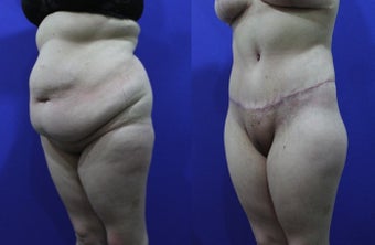 32 Year Old Female Treated for Abdominal Apron & Sagging Buttocks before 1109121