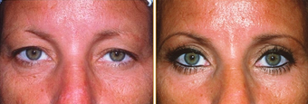 Eyelid Surgery before 271177