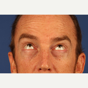 Eyelid Surgery after 3744025