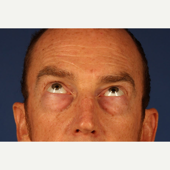 Eyelid Surgery before 3744025