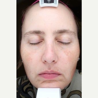 35-44 year old woman treated with Halo Laser before 2129481