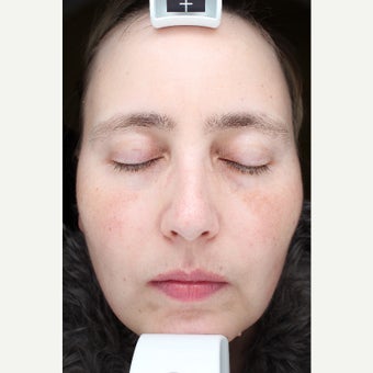 35-44 year old woman treated with Halo Laser after 2129481