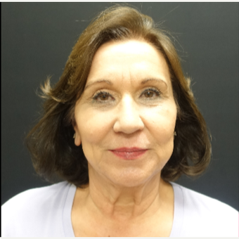 65-74 year old woman treated with Fat Transfer and Facelift before 3244858