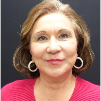 65-74 year old woman treated with Fat Transfer and Facelift after 3244858