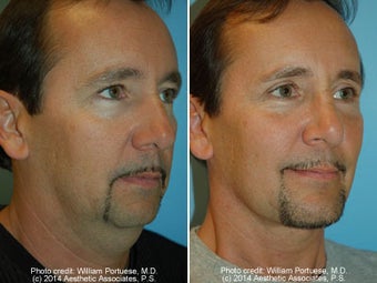 Neck Liposuction before 1389495