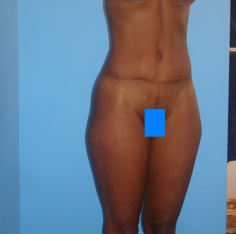 45 year old female treated for excess skin and fat of the abdomen 903188