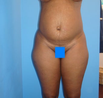 45 year old female treated for excess skin and fat of the abdomen before 903188