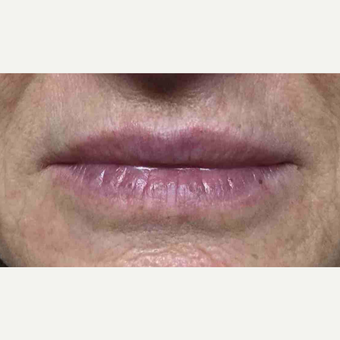 55-64 year old woman had lip augmentation with Restylane after 3169207