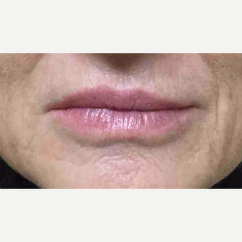 55-64 year old woman had lip augmentation with Restylane before 3169207