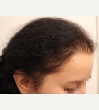 3-month results-female treated with PRP for Hair Loss - Dr. Patrick Mwamba (MyWHTC Clinic) in Europe after 2378073