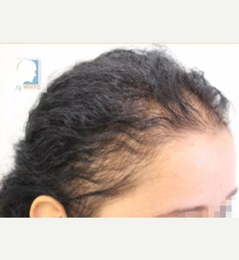 3-month results-female treated with PRP for Hair Loss - Dr. Patrick Mwamba (MyWHTC Clinic) in Europe before 2378073