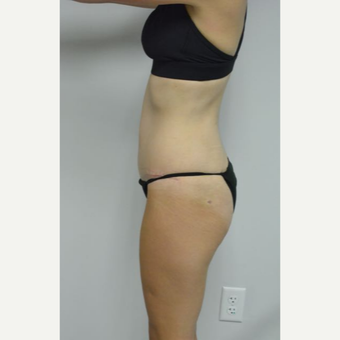 35-44 year old woman treated with Tummy Tuck and liposuction of her flanks and lower back after 3458999