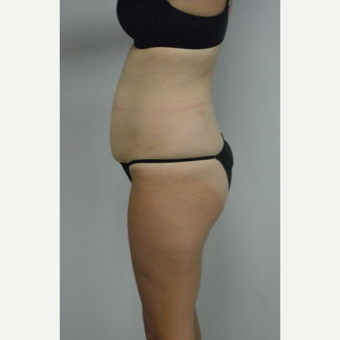 35-44 year old woman treated with Tummy Tuck and liposuction of her flanks and lower back before 3458999