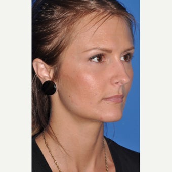 Rhinoplasty before 2381084
