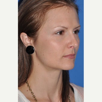 Rhinoplasty after 2381084